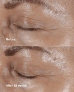 کرم دور چشم کلینیک